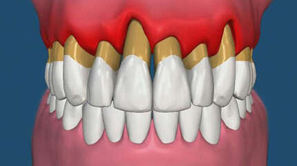 Пародонтоз — похититель улыбки