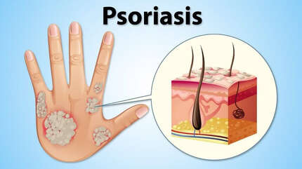 Псориаз — как выйти в ремиссию