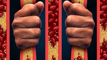 Атеросклероз — избавляемся от «побочных эффектов»