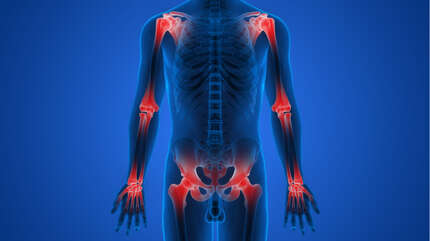 Остеоартроз — проще предупредить, чем лечить